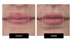CurrentBody Skin LED Lip Perfector - Appareil pour les lèvres
