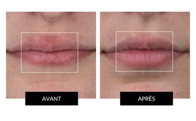 CurrentBody Skin LED Lip Perfector