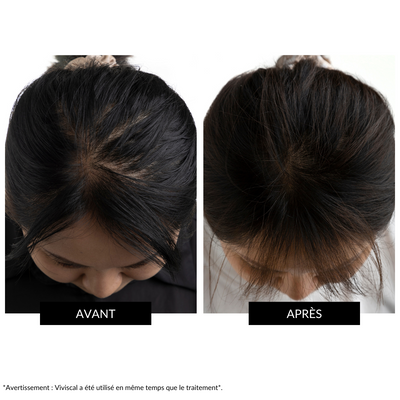 CurrentBody Skin - Appareil LED de repousse des cheveux offre