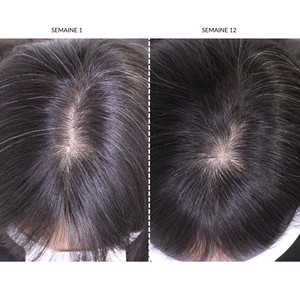 CurrentBody Skin - Appareil LED de repousse des cheveux