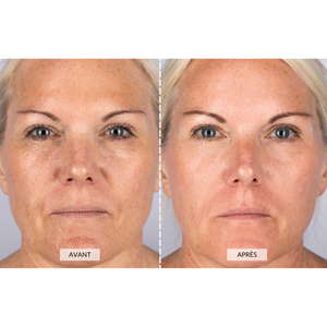 CurrentBody Skin RF Appareil radiofréquence visage