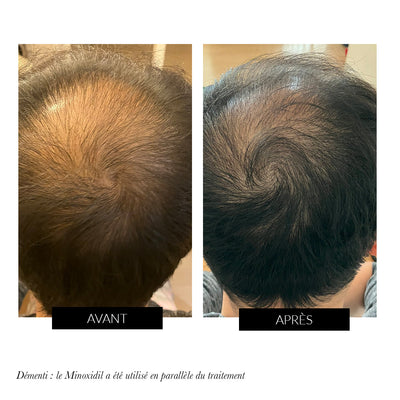 CurrentBody Skin - Appareil LED de repousse des cheveux offre