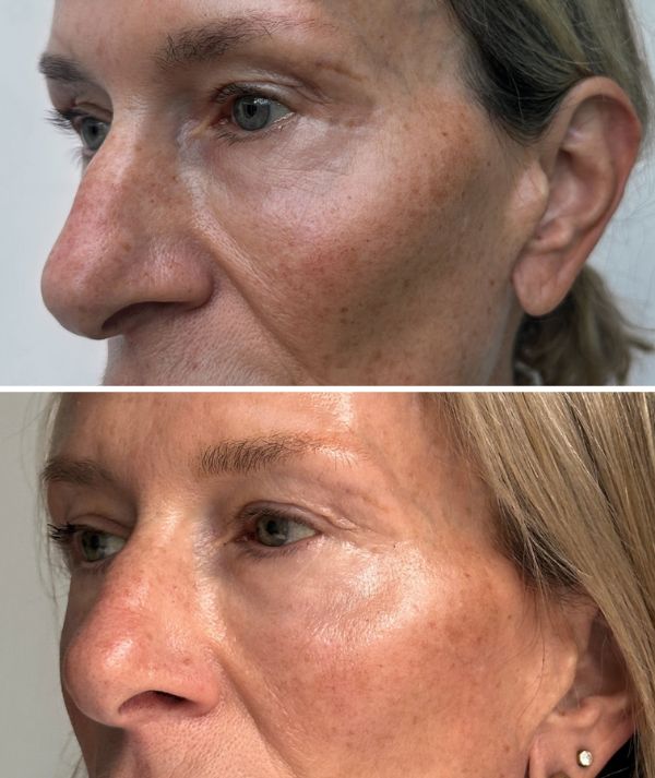 Hyperpigmentation