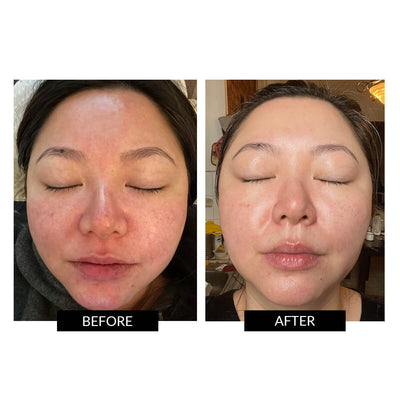 TriPollar STOP CLASSIC Facial Skin Renewal Device + CurrentBody Skin Radio Frequency Conductive Gel
