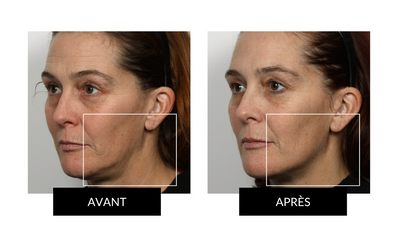 NuFACE mini - Tonifiant visage