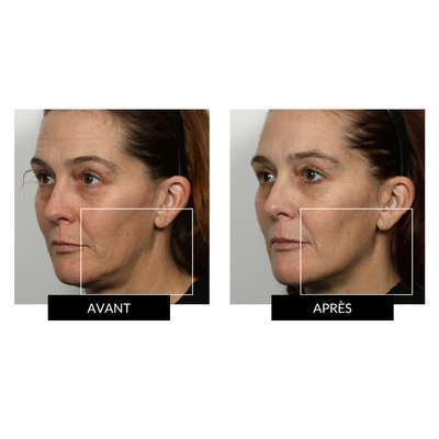 NuFACE Trinity - Kit tonifiant visage