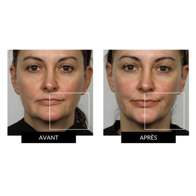 NuFACE Trinity - Kit tonifiant visage