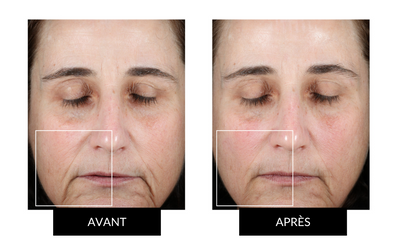 NuFACE mini - Tonifiant visage