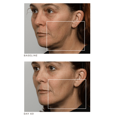 NuFACE Trinity - Kit complet de rajeunissement