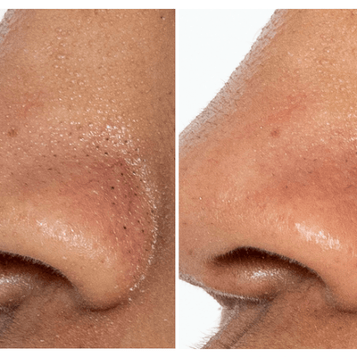 BeautyBio GLOFacial Outil de Nettoyage des pores Hydro-Infusion