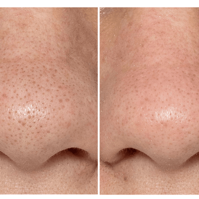 BeautyBio GLOFacial Outil de Nettoyage des pores Hydro-Infusion
